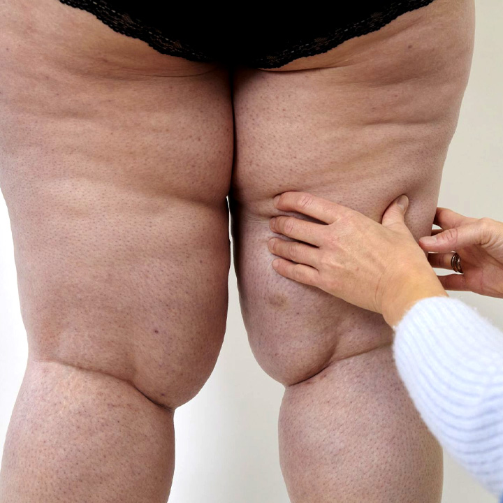 Diagnosis of Lipedema